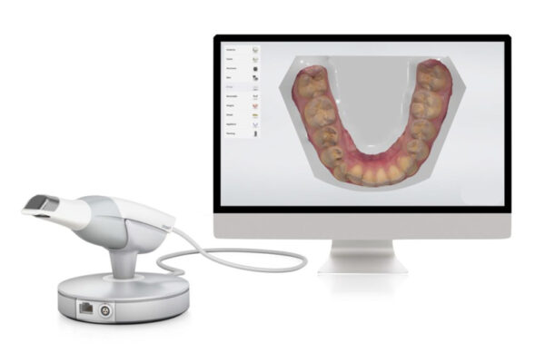 Lo scanner intraorale: a cosa serve?